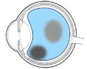 目の腫瘍について